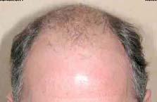 A new solution to treat patients suffering from hair loss (androgenic alopecia) 2.