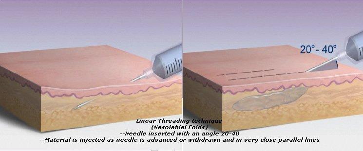 Injection Techniques Linear Threading Nasolabial Folds Needle