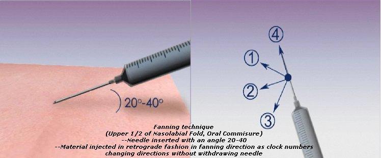 Injection Techniques Fanning Technique For upper ½ of Nasolabial folds and oral commisures Needle inserted at