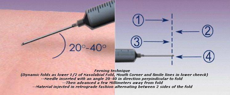 Injection Techniques Ferning Technique For Dynamic Folds as lower ½ of Nasolabial folds, Mouth Corners & Smile Lines in Lower Cheeck Needle inserted at