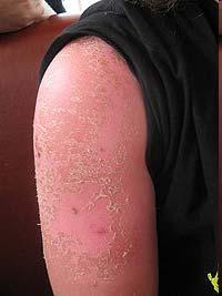 This is a picture of sunburn skin