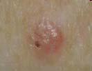 Basal cell carcinoma (BCC) is the most common form of skin cancer, affecting approximately one million Americans