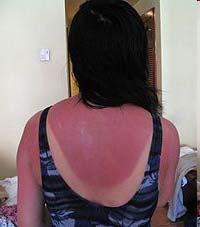 This is a picture of a sunburn, photographed 2 days after a 5-hour sun exposure.