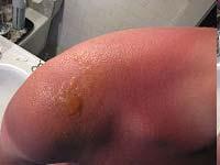 This is a picture of a blister on a person s shoulder.