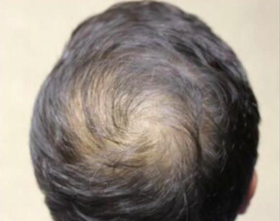 ARTICLE 1: MALE BALDING: More Complex than Imagined How many genes are implicated in male balding? In previous studies several genes were identified.