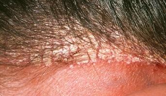 DANDRUFF INTRODUCTION Dandruff is a common skin condition that causes dry white or grey flakes of dead skin to appear in the scalp or hair.