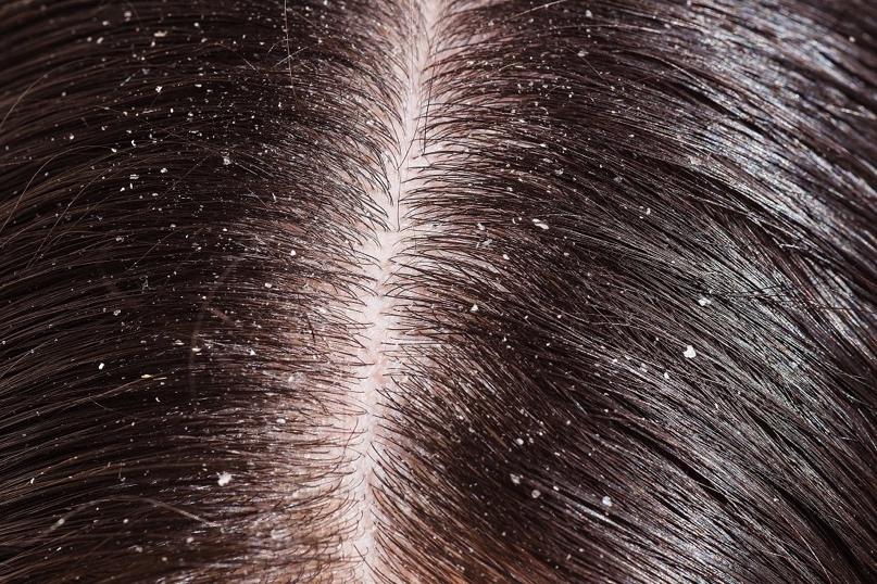 SYMPTOMS OF SEVERE DANDRUFF OR SEBORRHOEIC DERMATITIS Patchy yellowish flakes on your scalp with redness and soreness; many and obvious flakes throughout the length of your hair; tight, adherent