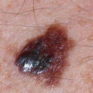 Skin cancer can be divided into two main groups: non-melanoma skin cancer and malignant melanoma. Malignant melanoma is the rarest form of skin cancer, but is the most serious and can kill.