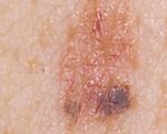 Medical advice should be sought if a mole changes shape (irregular outline), colour, increases in size, becomes itchy, painful, starts to bleed or becomes crusty and/or looks inflamed.