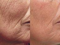 Years ago it was CO2 laser skin resurfacing a treatment that many cosmetic surgeons to this day still believe is one of the best skin rejuvenation therapies of our time.