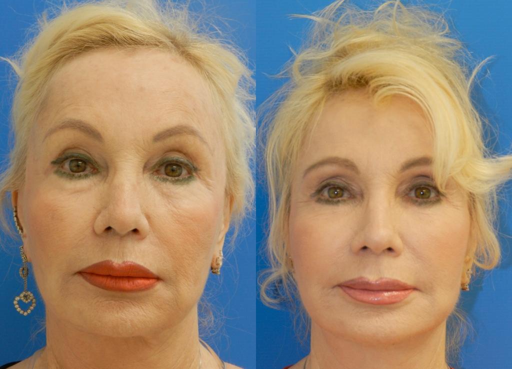 If you re not a candidate for a facelift and are looking to reverse the signs of aging just a bit longer, Thermage is the solution for you.