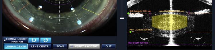 Refractive Cataract Surgery?