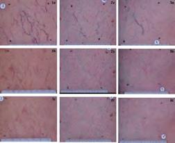 melanin pigment-patients with PIH have a tattoo -do not treat with