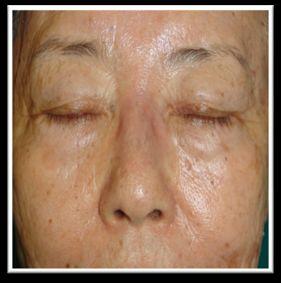 Laser Toning Treatment sessions