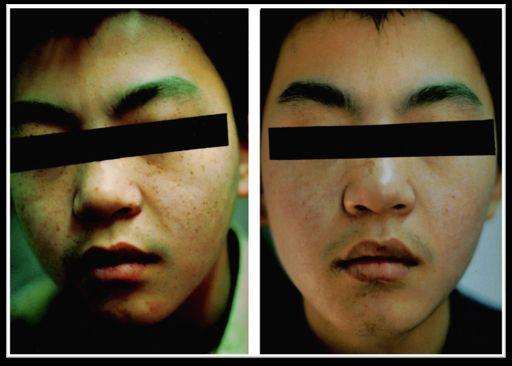 Epidermal Lesion: Freckles Wavelength: 532 nm Spot size