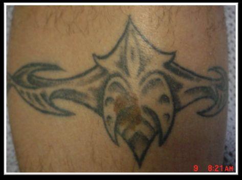 Tattoo Removal Post 2