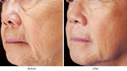 Skin Tightening A loss of collagen and elastic in the dermis creates lines, wrinkles and sagging skin.