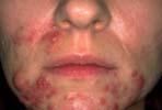 In humans, pimples tend to appear on the face, back, chest, shoulders and neck.
