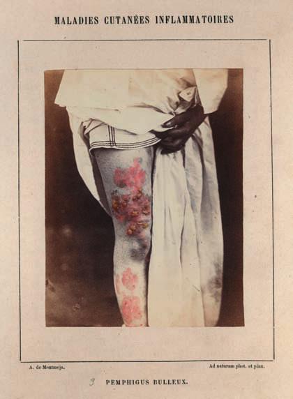 The colours of life Figure 5.5 Patient revealing her affected skin. Pemphigus bulleux. In Hardy, A., & de Montméja, A. (1868). BIUM Paris. http://www.bium.univ-paris5.fr/histmed/medica/page?