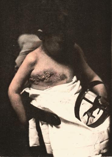 9 Example of clothing and jewellery in medical photographs. Impetigo. In Hardy, A.