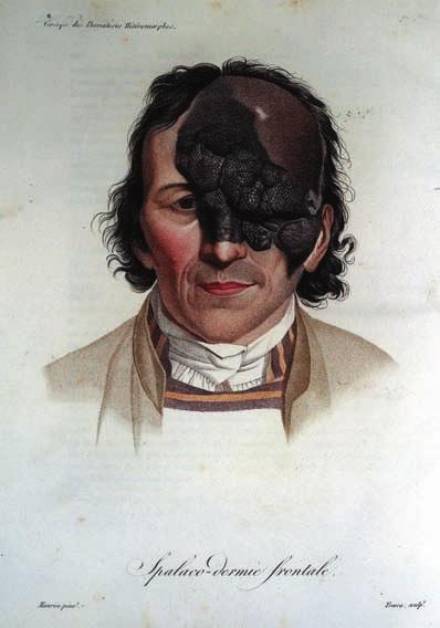 Surface of recognition Figure 2.6 Portrait-like illustration Spalaco-dermie frontale. In Alibert s Monographie des dermatoses, ou, précis théorique et pratique des maladies de la peau (1832) 