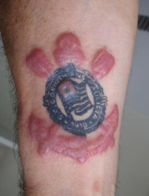 Tattooing - Allergic Reactions -