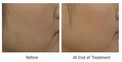 protocol) Before After Before Improvement seen especially with skin Texture,