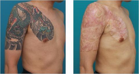 Why the conventional tattoo removal wisdom, that laser removal is the only option or the most effective not only hurts your wallet but also sometimes leaves you with completely avoidable scars!