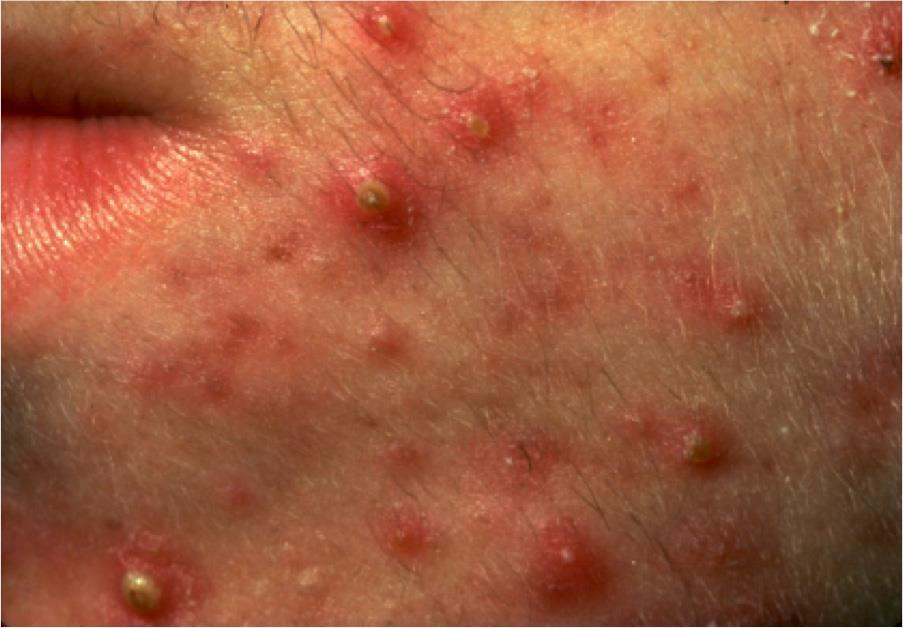 Extensive pustules with