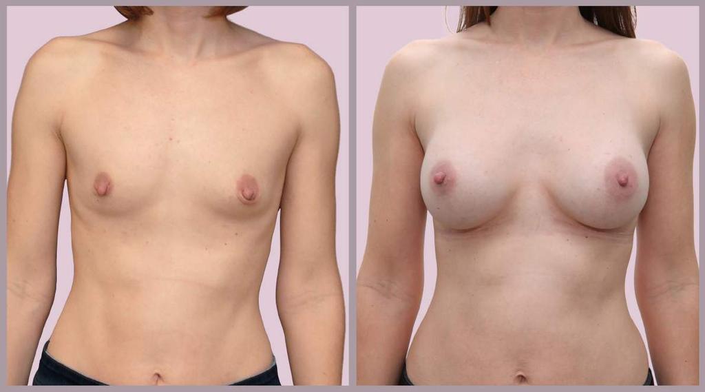 Breast Augmentation After Pregnancy Breast Augmentation with Saline implants (350cc