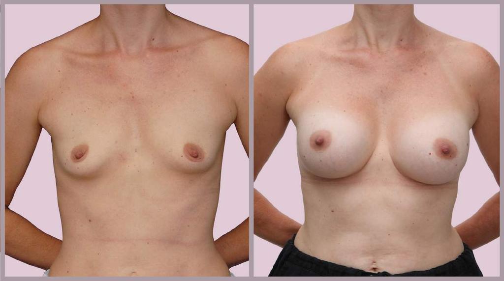 Breast Augmentation After Pregnancy Breast Augmentation with Silicone Implants (286cc