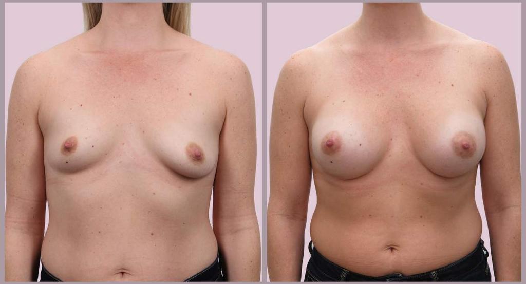 Breast Augmentation After Pregnancy Breast Augmentation with Silicone