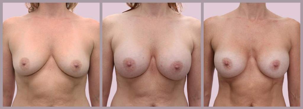 Breast Augmentation after Weight Loss before: 36C 2 month result: 36/38D 2 year result: 36C, weight