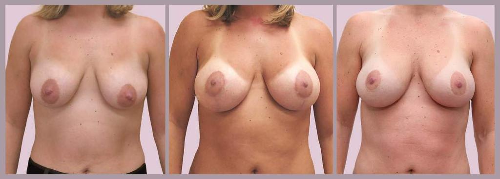 Breast Augmentation and Lift Over Time before 6 month result 10 year result Breast
