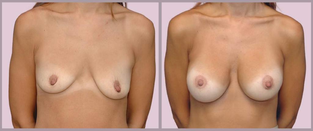 Correcting Breast Asymmetry Breast Augmentation with Silicone implants (397cc