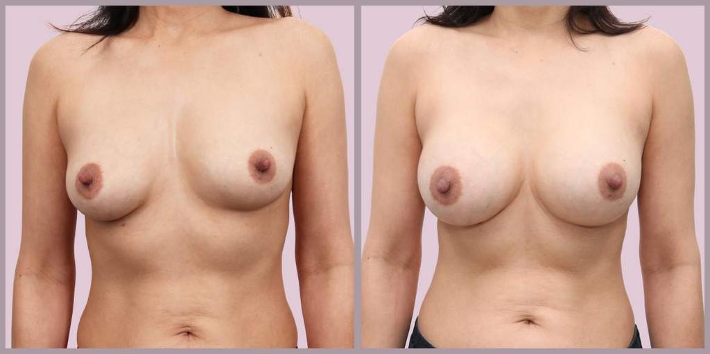 Correcting Breast Asymmetry Breast Augmentation with Silicone implants