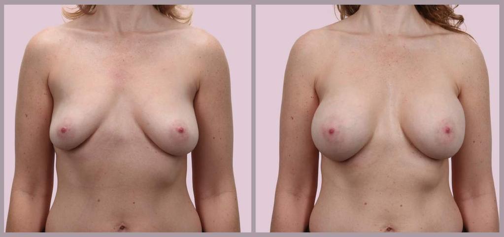 Correcting Breast Asymmetry Breast Augmentation with Silicone implants (L: 286cc