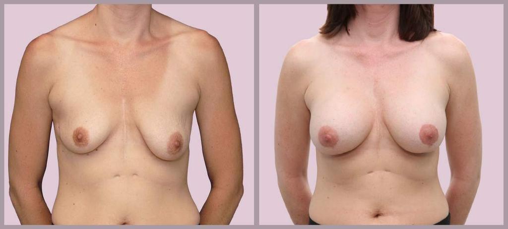 Correcting Breast Asymmetry Breast Augmentation with Silicone implants and Breast Lift with Minimal Scar