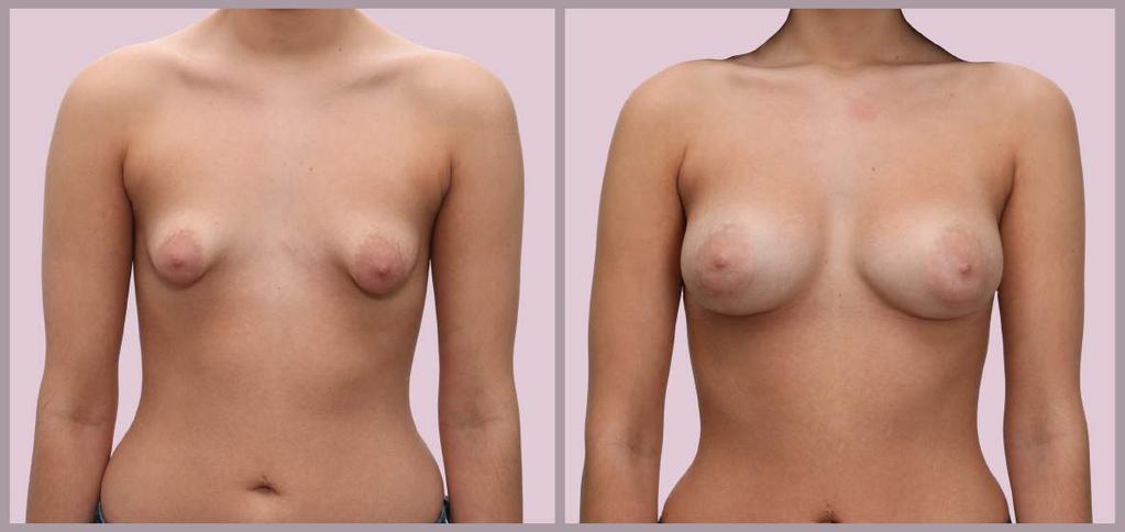 Breast Augmentation: Small Breasts Breast Augmentation with Saline implants