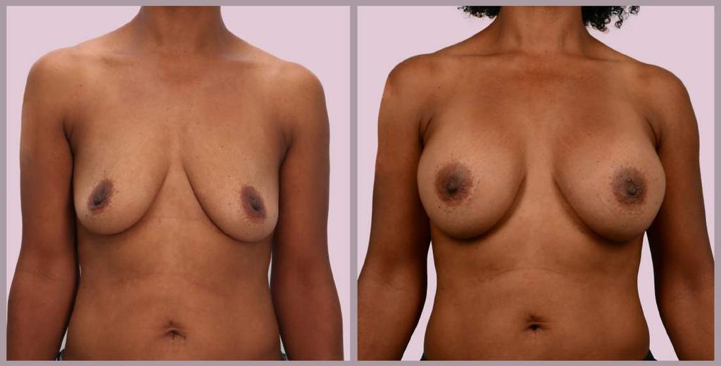 Breast Augmentation Breast Augmentation with Silicone implants