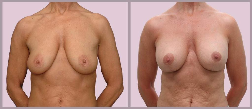 Breast Augmentation and Lift Breast Augmentation with Silicone implants and "Lollipop Lift"