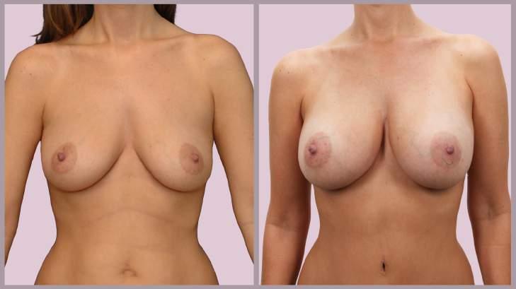 Breast Augmentation Breast
