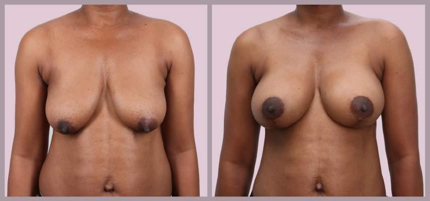 Breast Augmentation and Lift Breast