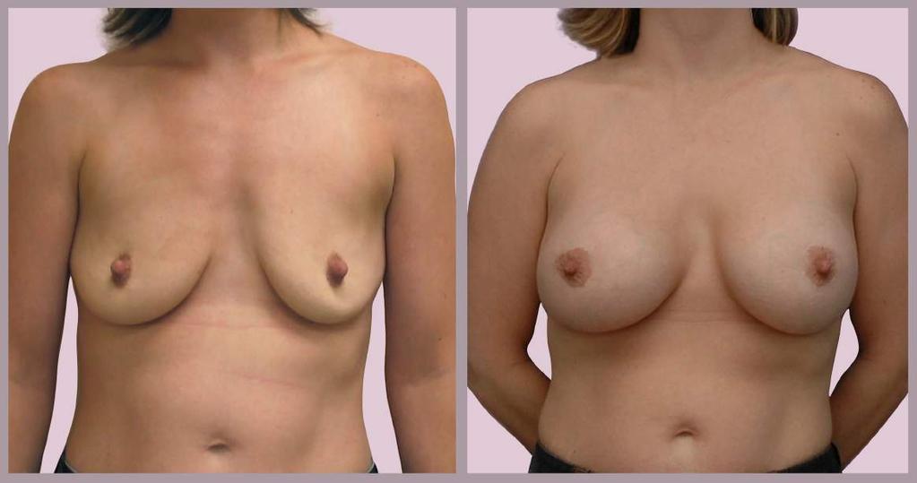 Breast Augmentation and Lift Breast Augmentation with Saline implants (425cc