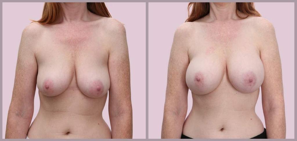 Breast Augmentation Breast Augmentation with Silicone implants