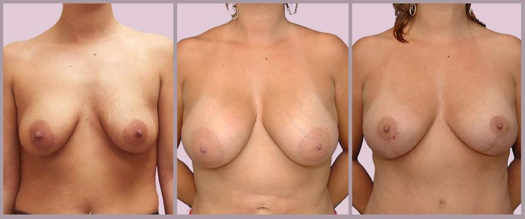 Secondary Breast Surgery before 36C 7 year result 36-38DD (wt inc 21lb) Breast Implants