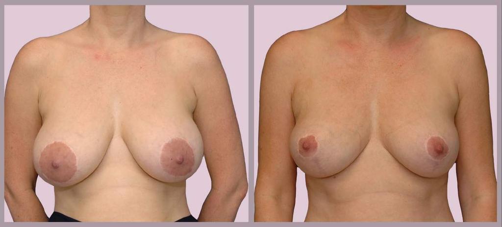 Secondary Breast Surgery Breast Implant Removal and Breast Lift (removed 325cc
