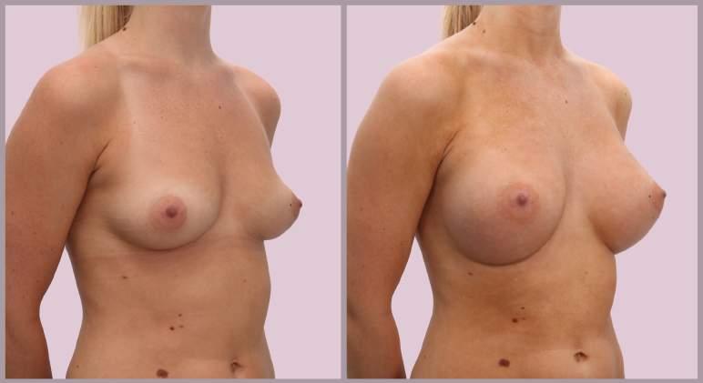 Breast Augmentation with