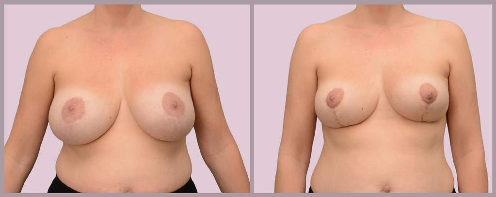 Secondary Breast Surgery: Desire for Smaller Breasts Removal of Saline implants (400cc) and