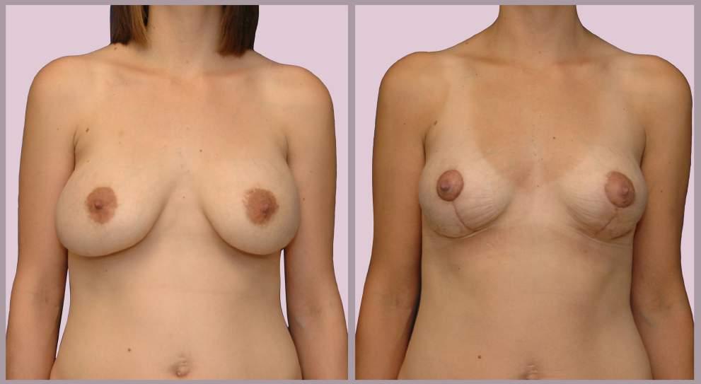 Secondary Breast Surgery: Desire for Smaller Breasts Exchange of implants (375cc Saline to